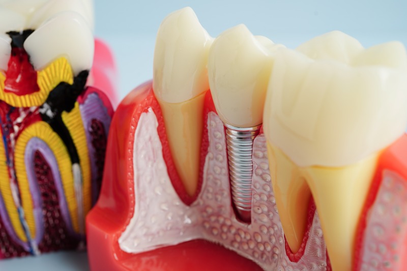 dental implants Derby