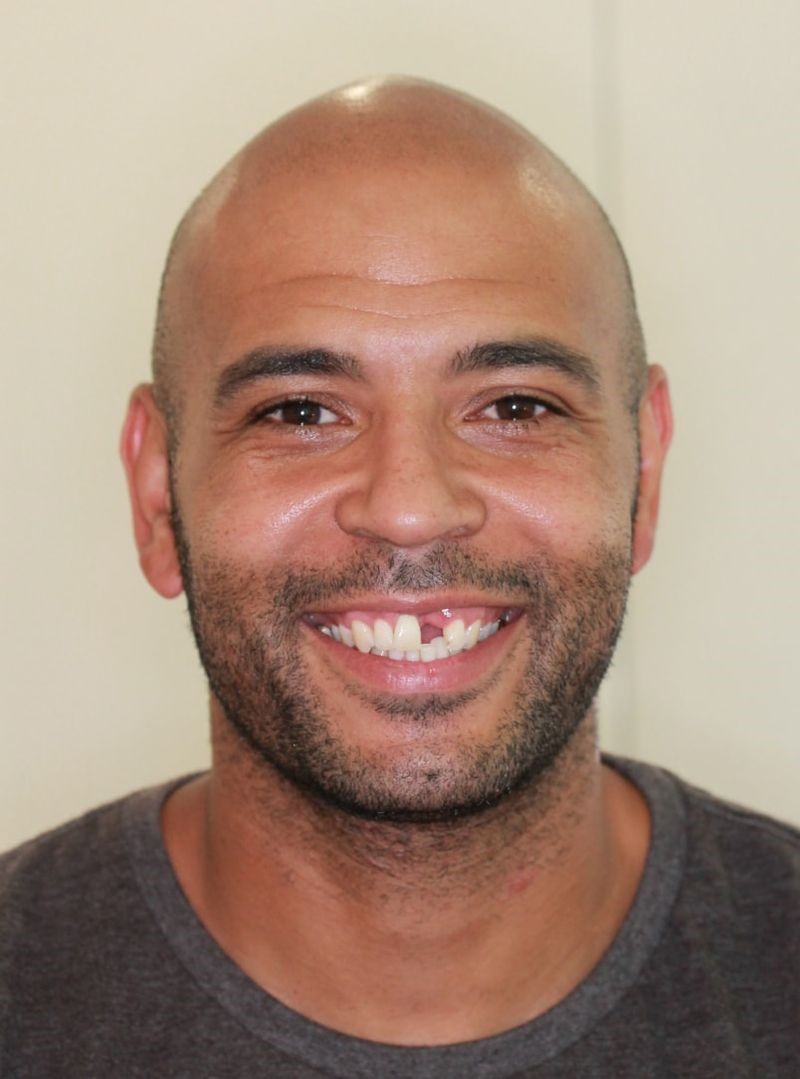 Before Dental Implant Smile
