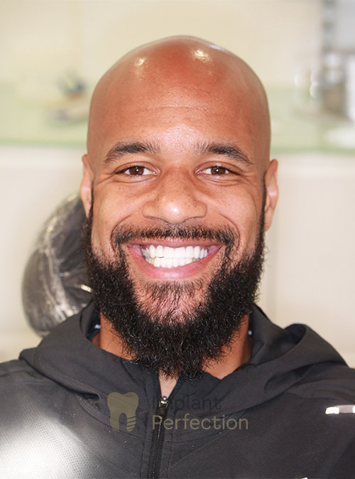 After Dental Implants treatment