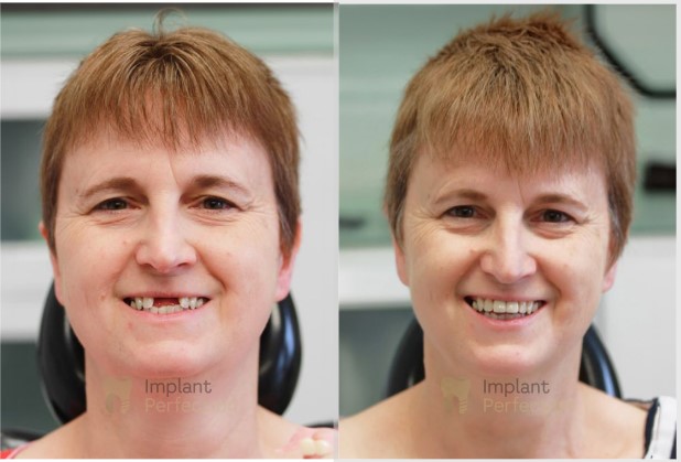 Dental implants Derby