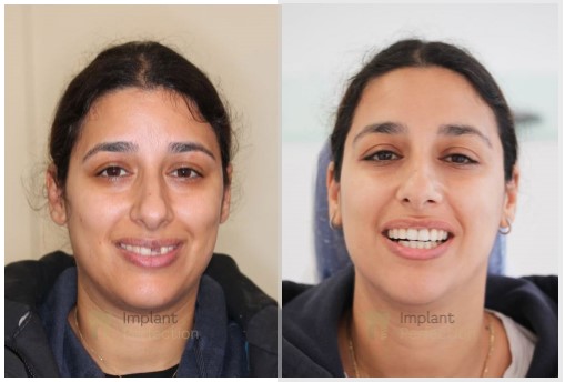 Dental implants dentist