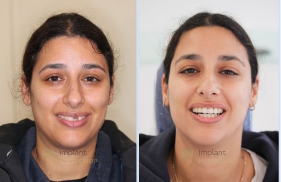 Dental implants in Derby