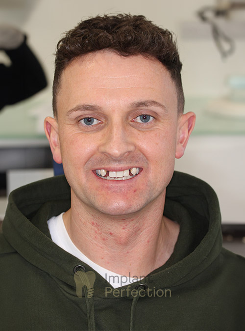Before Dental Implants treatment