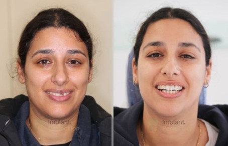 Local dental implant dentist