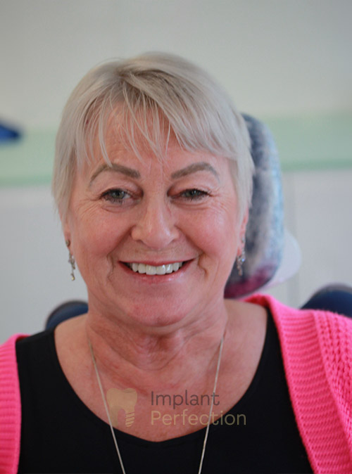 After Dental Implants treatment