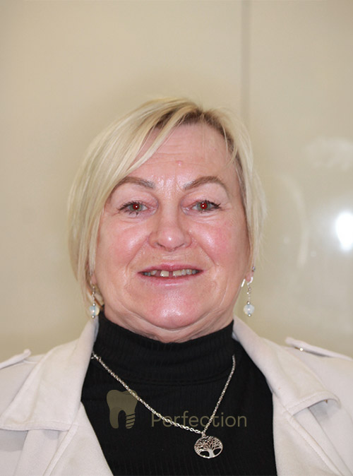 Before Dental Implants treatment