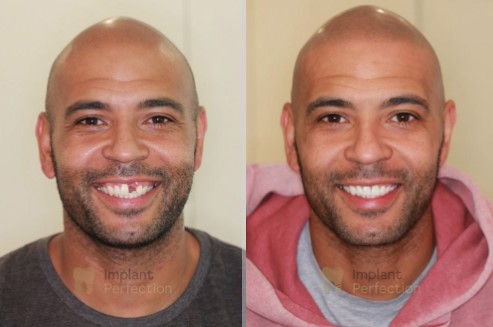 Pain-free dental implants in Derby
