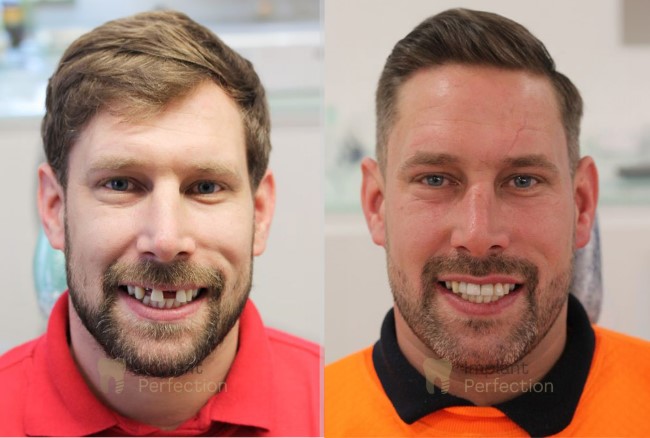 Painless dental implants Derby