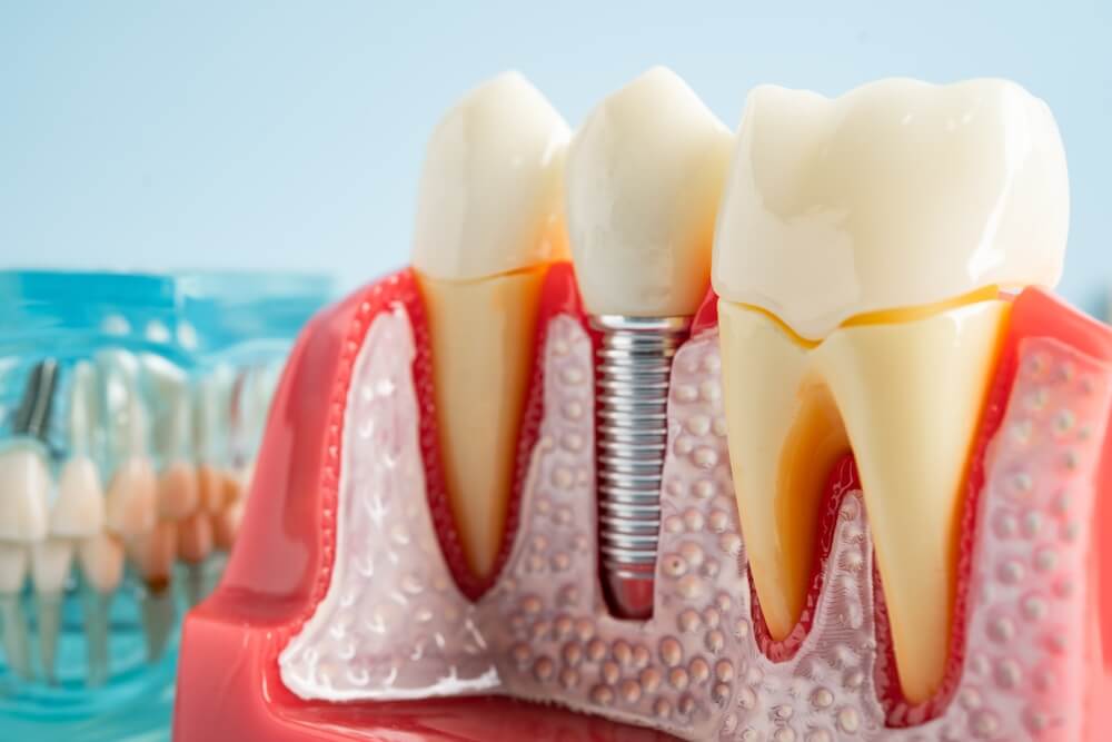 Painless dental implants in Derby