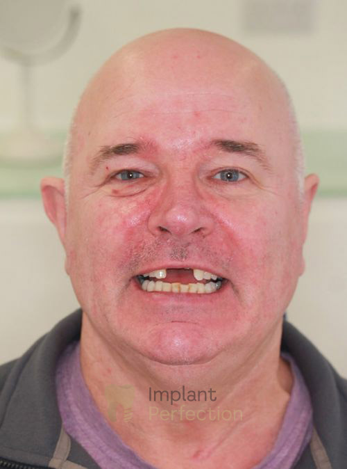 Before Dental implants dentist