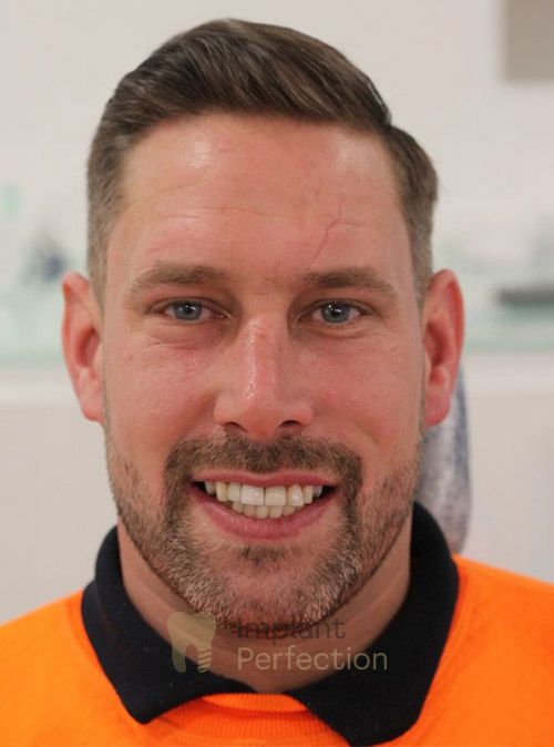 After Dental Implants Results