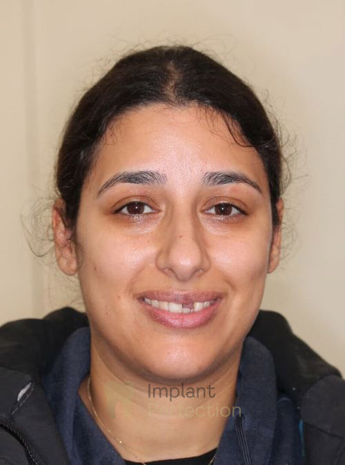 Before Dental Implants treatment