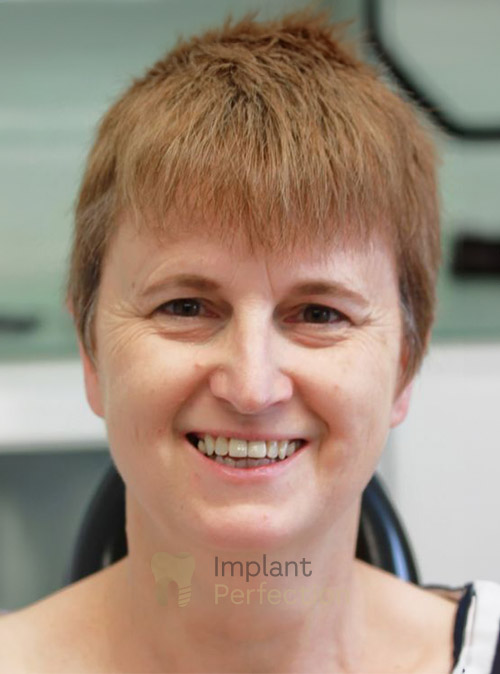 Dental implants dentist results