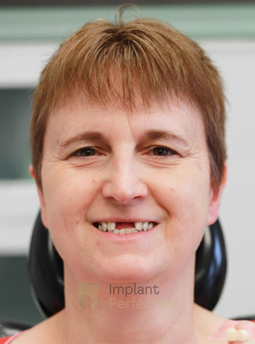 Before Dental implants dentist