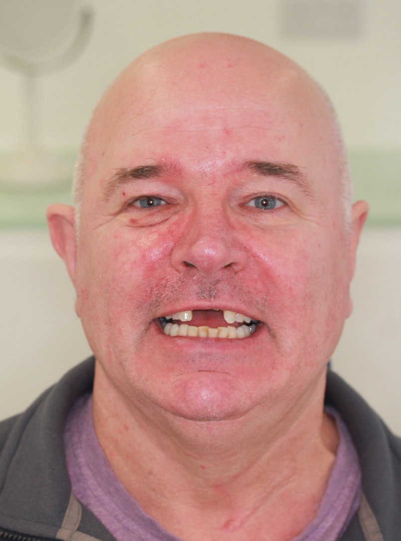 Before Dental Implant Procedure - Tooth Loss
