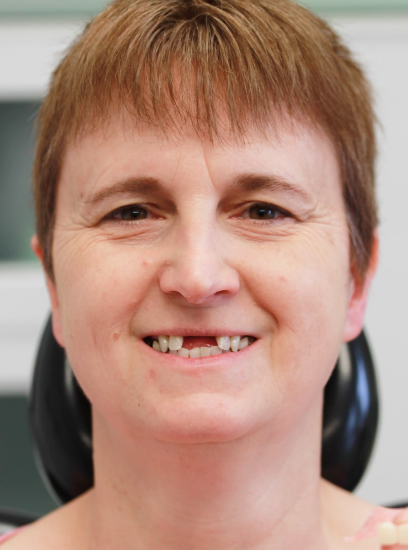 Before Dental Implants - Multiple Missing Teeth