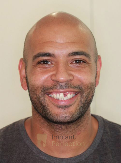 Before Dental Implant 