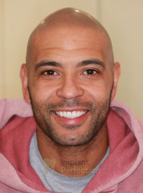 Dentist for dental implant results