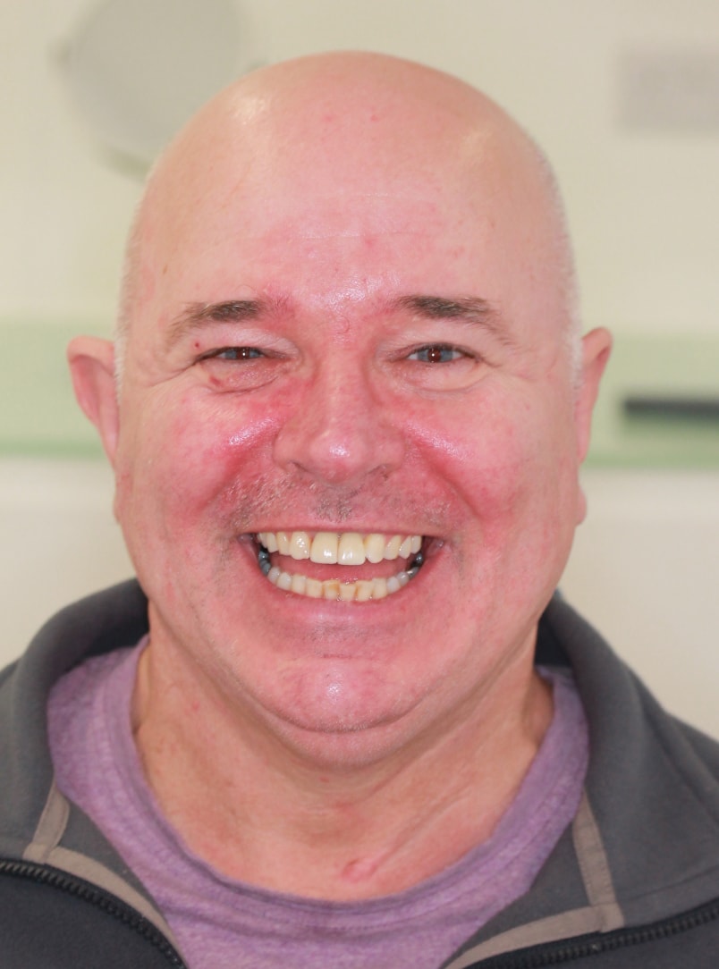Dental implants dentist results