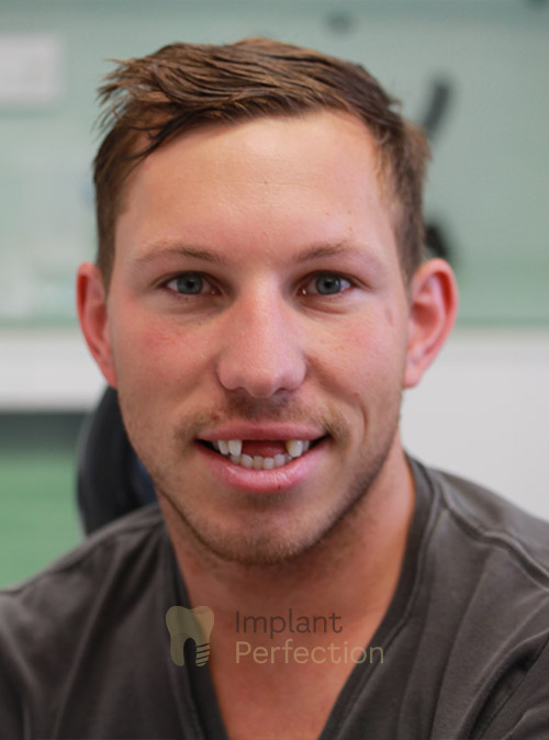 Before Dental Implants treatment