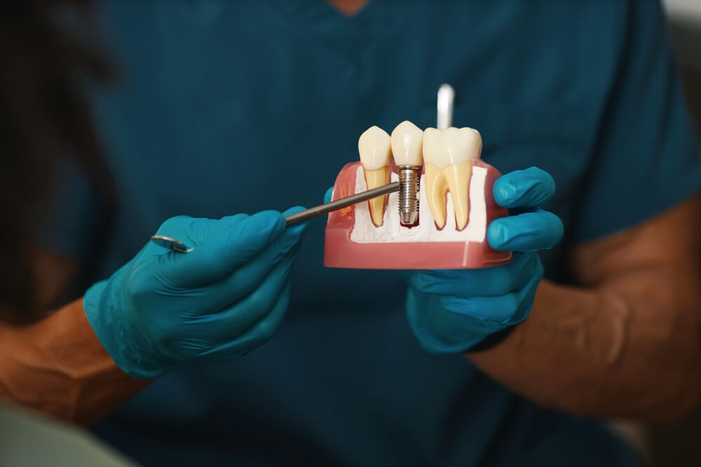 Same day dental implants Derby