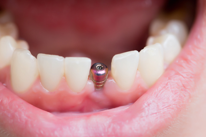 Single Mouth Implants