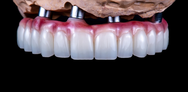 dental implants Burton on Trent