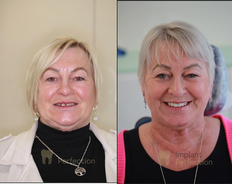 dental implants derby
