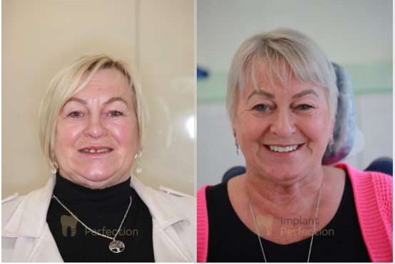 Dental implants Derby
