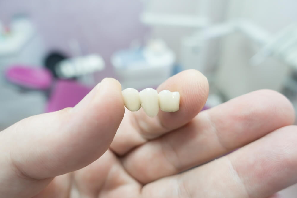 dental implants in Burton-on-Trent
