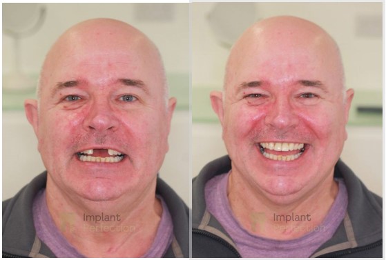 Derby dental implants
