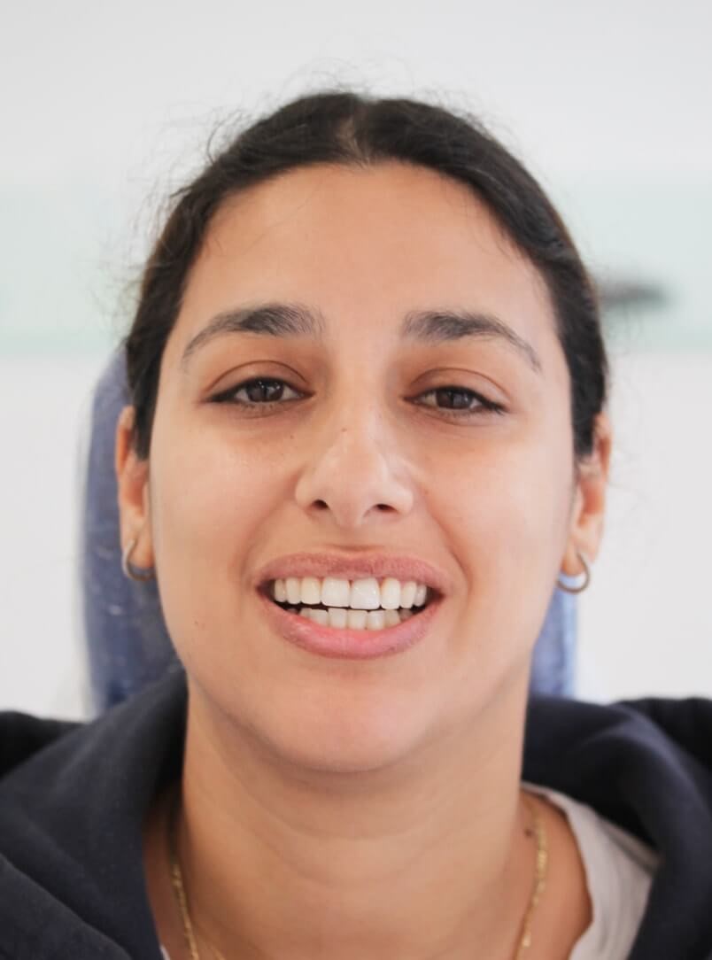 After Dental implant results